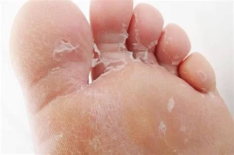 What causes skin peeling on bottom of feet? Real Facts