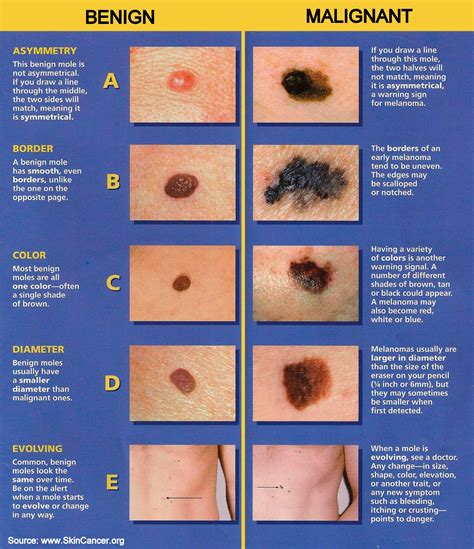 Skin Cancer: Skin Cancer Check Up