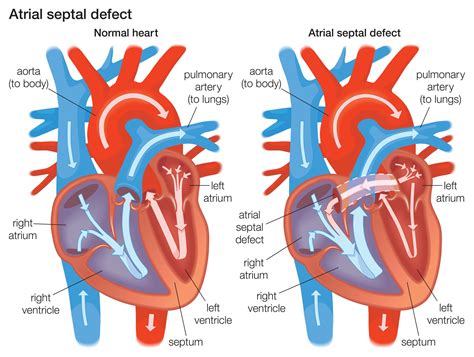 Atrial Septal Defect (ASD) Explained