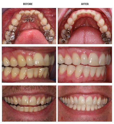 Before and after inman aligners from our Raleigh Dentist Learn more at ...