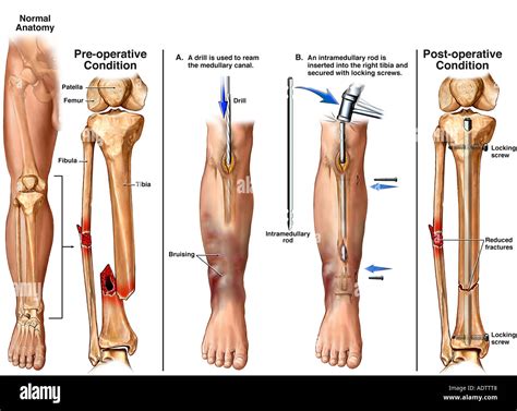 Tibia Fibula Fracture