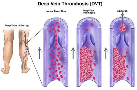 What Is the Difference Between Thrombus and Embolism?