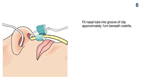 AMT Bridle Family | Nasal Tube Retaining System & Pediatric