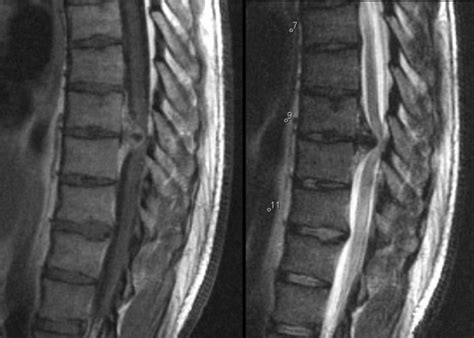 Herniated Disc Thoracic Mri