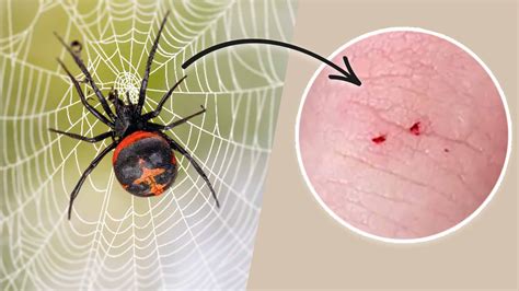 Black Widow Spider Bite Stages: Symptoms and Recovery