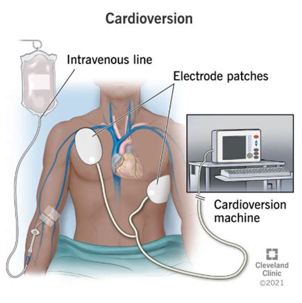 electric cardioversion - Agency One