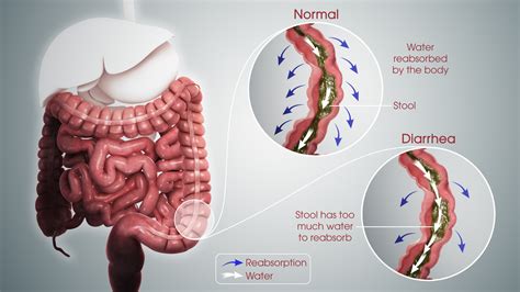 Diarrhea: Pathophysiology, Treatment, and Management