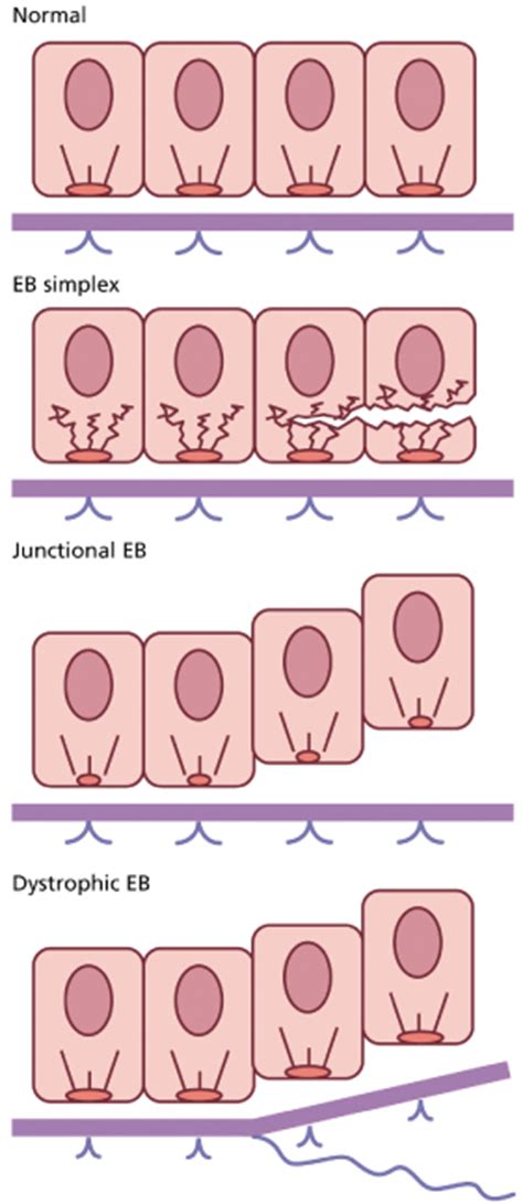 118 Epidermolysis Bullosa | Plastic Surgery Key