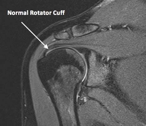 SHOULDER MRI - Upper West Side, Columbus Circle New York, NY