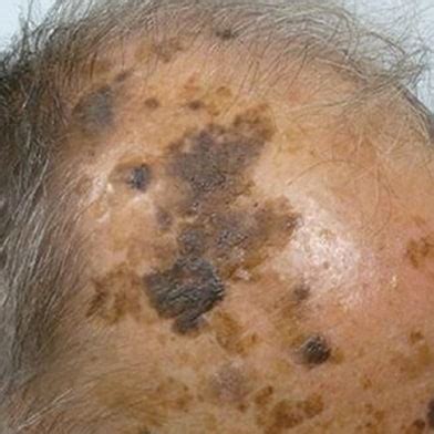 Seborrhoeic Warts (Keratosis) - Skin Surgery Clinic