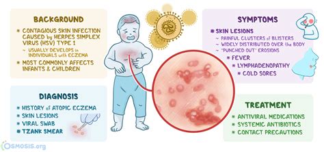 Eczema Herpeticum: What Is It, Causes, Diagnosis, and More | Osmosis