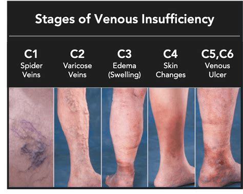 Venous Stasis Ulcer Treatment Pictures Causes Symptoms