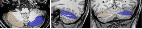 Crus I in axial, sagittal and coronal view. Blue: left Crus I. Light ...