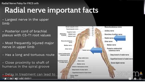 Radial Nerve Injuries for the FRCSOrth Exam — OrthopaedicPrinciples.com