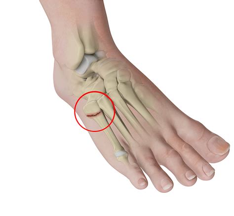 5th Metatarsal Fracture Symptoms