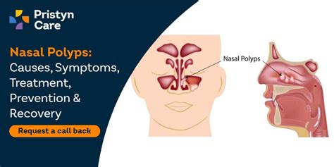 Nasal Polyps: Causes, Symptoms, Treatment, Prevention & Recovery ...