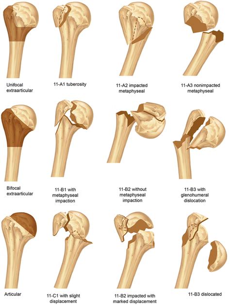 Anatomy and Classification of Proximal Humerus Fractures ...