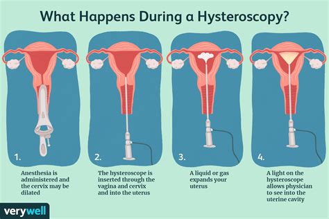 Actualizar 109+ imagen office hysteroscopy - Abzlocal.mx