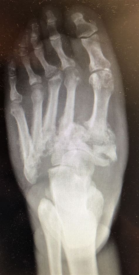 Charcot foot : Radiology