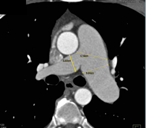 Dilated Main Pulmonary Arteries with Good Visualization of Pulmonary ...