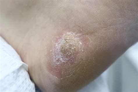 Plantar Warts: What Causes Them and Symptoms to Look for