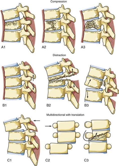 Diagnosis and Management of Thoracic Spine Fractures | Neupsy Key