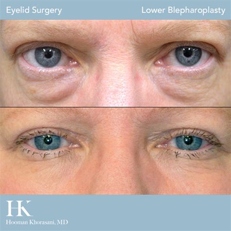 9 Tips to Speed Recovery After Eyelid Surgery (Blepharoplasty)