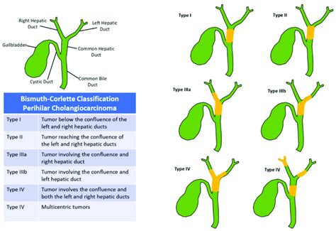 Cholangiocarcinoma Type