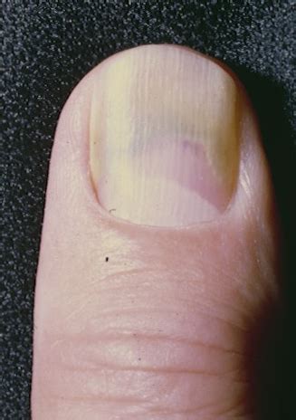 Green Nail Syndrome (GNS, Pseudomonas nail infection, chloronychia ...