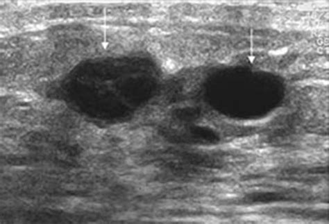 Breast Ultrasound Cancer vs Benign Breast - Cancer OZ