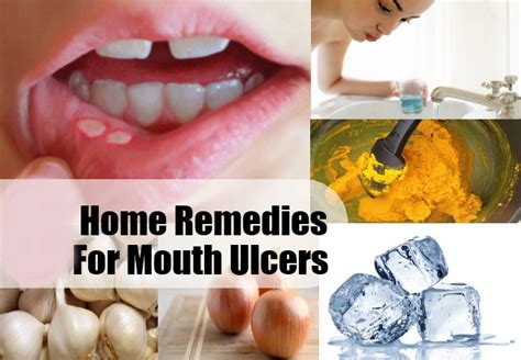 Perfect Home Remedies For Mouth Ulcers - Life Health Max