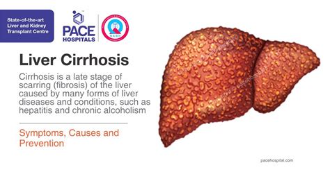 Liver Cirrhosis – Symptoms, Causes, Complications and Prevention