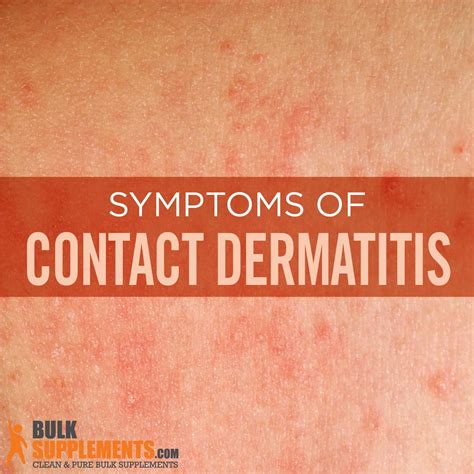 Contact Dermatitis: Symptoms, Causes & Treatment