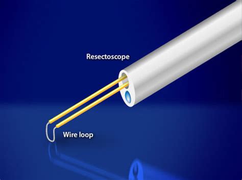 Video - Hysteroscopic Polypectomy - HealthClips Online