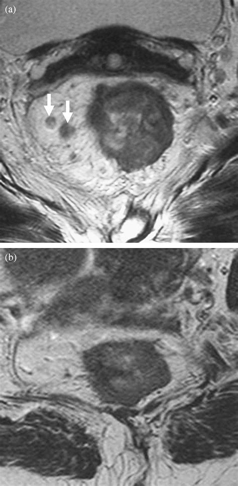 Evaluating Mesorectal Lymph Nodes in Rectal Cancer Before and After ...