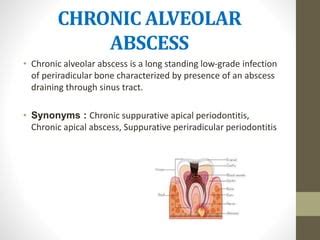 Periapical Abscess.pptx