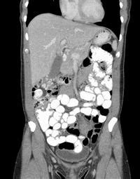 Abdomen / Pelvis CT Scan: St. Elizabeth's Medical Center | Steward ...