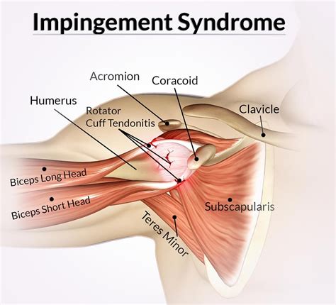 Shoulder Impingement Syndrome | Local Physio