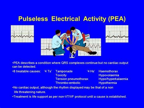 Pin on ECGs