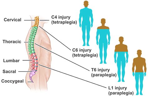 Cervical spinal cord injury treatment