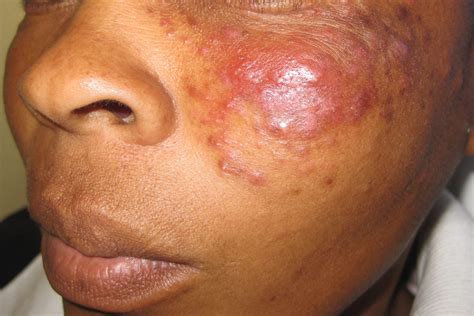 Granulomatous Rosacea (Granulomatous Facial Dermatitis, Lupoid Rosacea)