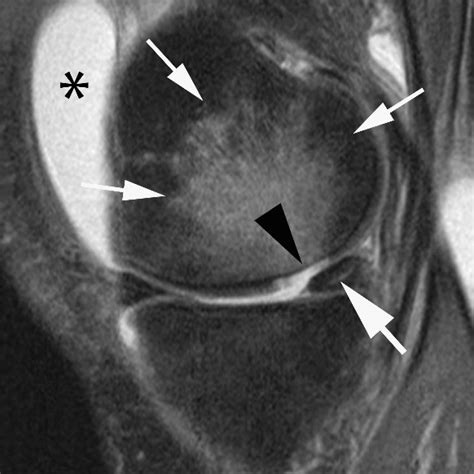 MRI Findings Reveal Early Changes to Joint That Predict Development of ...