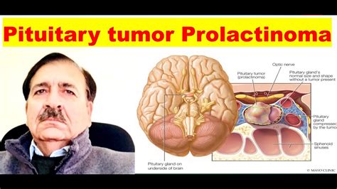 Prolactinoma Signs Symptoms diagnosis and Treatment, Lectures by Dr ...