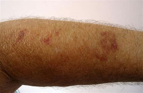 Skin diseases more common in elderly men: Study , http://bdc-tv.com ...