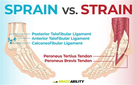 A Sprain, a Twist, or a Roll? Decipher Your Ankle Injury.