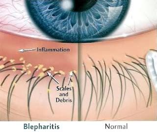 Doctors Gates: Squamous Blepharitis