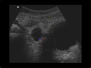 Urinary Tract and male reproductive system | 2.2 Bladder : Case 2.2.3 ...