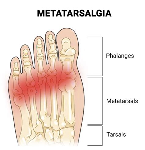 Ball of Foot Pain (Metatarsalgia) - Premier Podiatry: Velimir Petkov ...