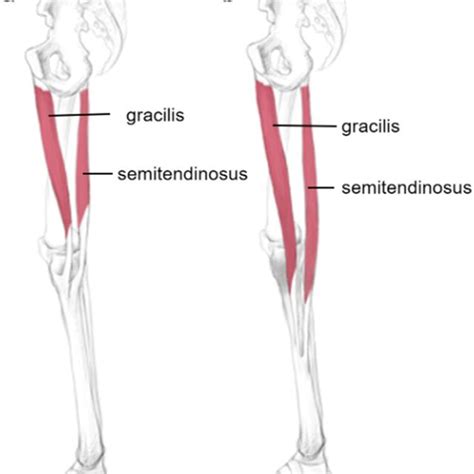 Ultrasound was used to explore the left semitendinosus tendon at the ...