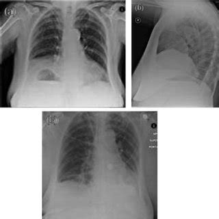 Plain film radiology. (A) Posteroanterior chest radiograph showing the ...